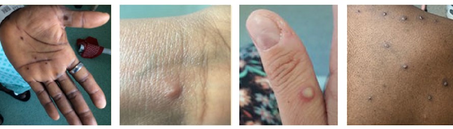 mpox visuals
